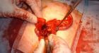 'Emergency' appendix surgery can wait: MDs