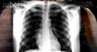 Tuberculosis case confirmed in St. John's