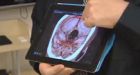 Doctors diagnose stroke with iPhone app