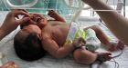 Chinese twins born in single body with 2 heads