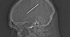 No joke: 3-inch nail removed from U.S. man's brain