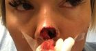 Boyfriend bit nose off during New Year's argument, woman says