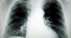 Lung cancer trigger discovered