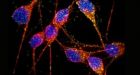 Transforming Skin Cells into Neurons Leads to New Insights for Alzheimer's